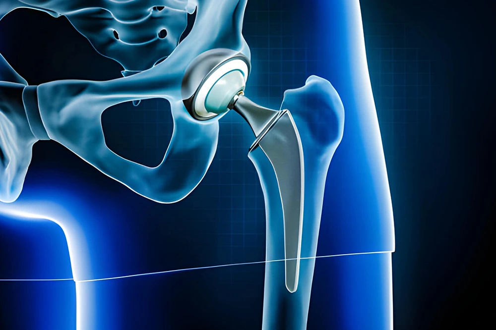 Hip Replacement Surgery