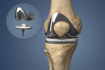 Knee Replacement